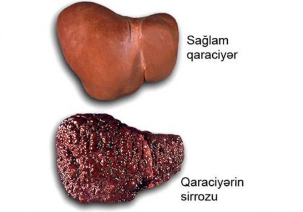 Qaraciyərdə xəstəliyin olmasını necə bilmək olar?