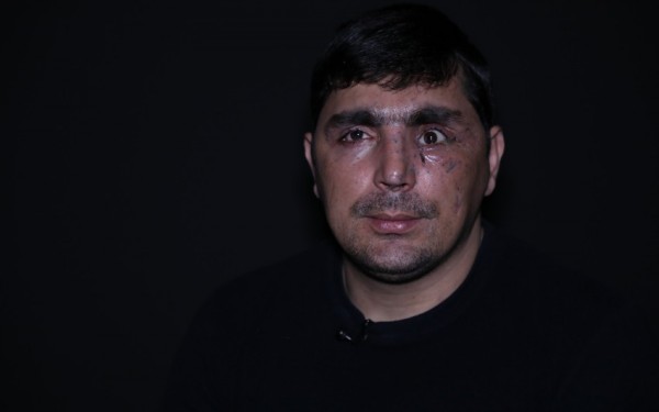 Qarabağ qazisi: "Qulaqlarım partlayıb, burnum, gözüm zədələnib"