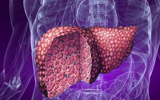 Hirs, qəzəb və depressiya qaraciyər xəstəliyinin əlamətidir Hirs, qəzəb və depressiya qaraciyər xəstəliyinin əlamətidir