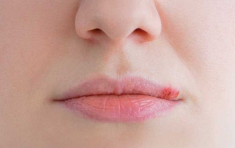 Herpes hər kəs üçün təhlükəli deyil Herpes hər kəs üçün təhlükəli deyil