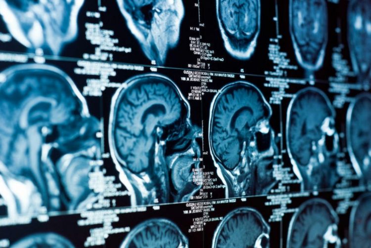 Daha çox insanı insultdan belə qorumaq olar: ilk 45 dəqiqə ərzində... Daha çox insanı insultdan belə qorumaq olar: ilk 45 dəqiqə ərzində...