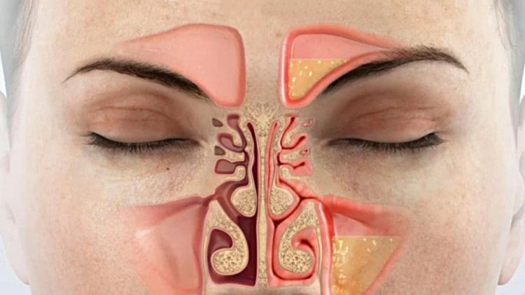 Şişmiş burun ətlərini kiçildir:  Gündə 1 stəkan kifayətdir... Şişmiş burun ətlərini kiçildir:  Gündə 1 stəkan kifayətdir...