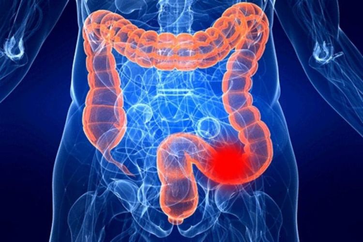 Kolon xərçənginin üç xəbərdaredici əlaməti müəyyən edilib Kolon xərçənginin üç xəbərdaredici əlaməti müəyyən edilib