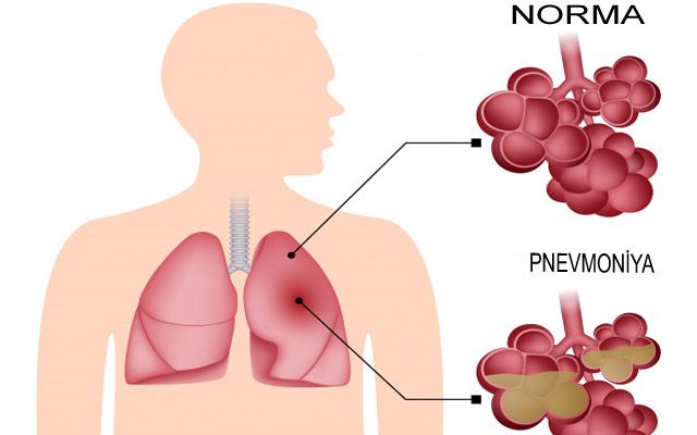 SN: Mövsümi virus infeksiyalarının artması pnevmoniya riskini yüksəldir