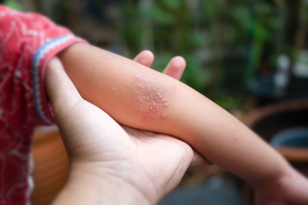 Rusiyada uşaq bağçasında enterovirus infeksiyası yayılıb